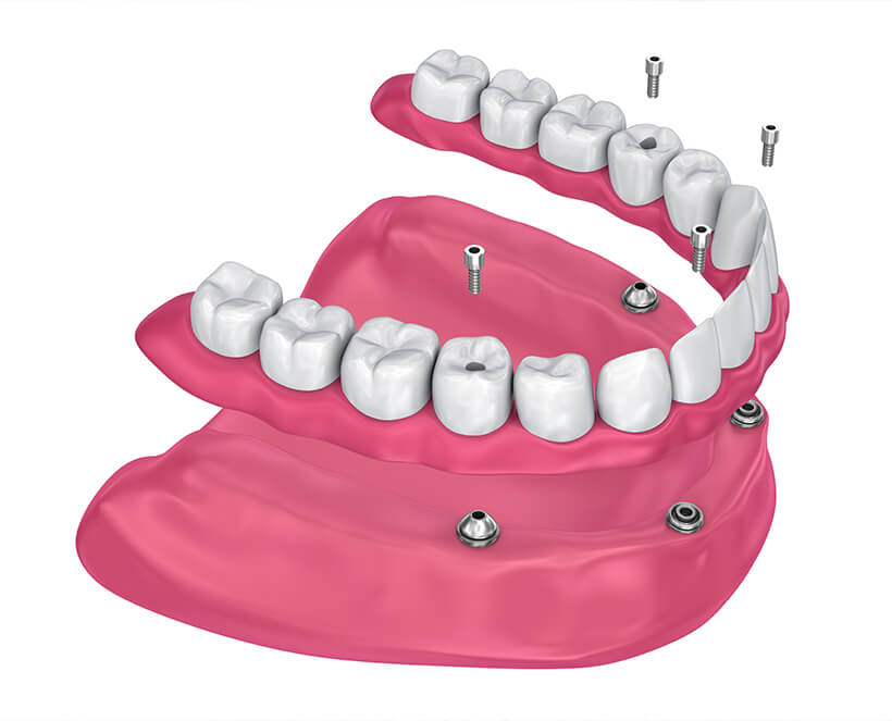 illustration of implant-supported dentures