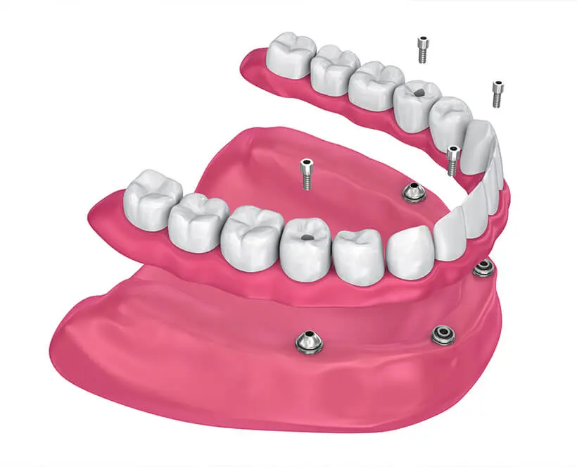 国内外の人気が集結 CO Gypsum, In Dentures High-Quality | Dental Family Altitude ジャケット・アウター
