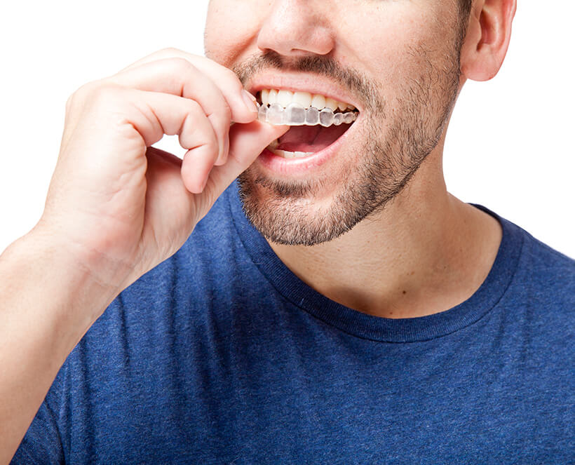 man inserting clear aligners onto his teeth