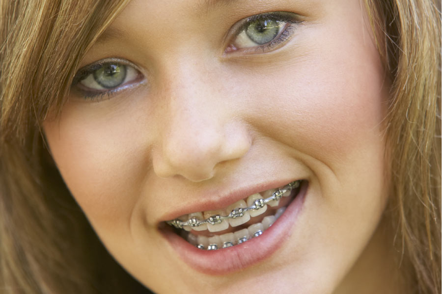 young woman smiles showing off her new braces