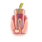 root canal therapy in gypsum, co on molar tooth in pain