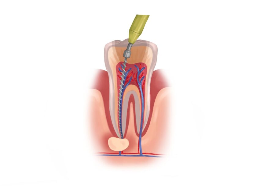 root canal therapy in gypsum, co on molar tooth in pain